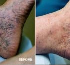 The Most Effective Natural Remedy For Varicose Veins and Hemorrhoids