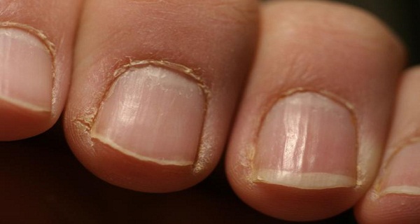 Red Alert If You See This On Your Nails, Visit A Doctor Immediately!