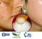 Facial Spots Will Disappear In Seconds Try Out This Homemade Recipe