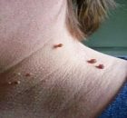 Fibroid Tumors – Warts, How To Remove Them Without Going To The Doctor