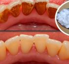 This Can Even Whiten Extremely Yellow Teeth And Remove That Nasty Plaque And Tartar Buildup