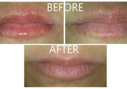 home-remedies-for-chapped-lips