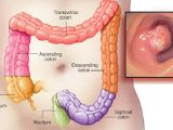 6-early-warning-signs-of-rectum-cancer-everyone-is-too-embarrassed-to-talk-about