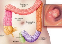 6-early-warning-signs-of-rectum-cancer-everyone-is-too-embarrassed-to-talk-about