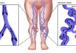 get-rid-of-varicose-veins-at-home