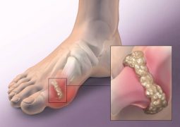 how-to-quickly-remove-uric-acid-crystallization-from-your-body-to-prevent-gout-and-joint-pain