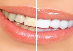 how-to-whiten-your-teeth-using-natural-remedies-and-why-you-should-do-it