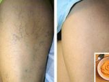 the-most-effective-natural-treatment-for-varicose-veins1