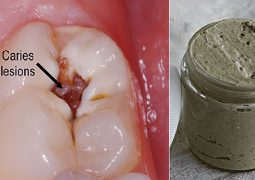 heal-cavities-gum-disease-whiten-teeth-natural-homemade-toothpaste