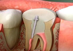 root_canal-1